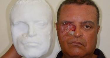 Этому мужчине сделали протез лица при помощи смартфона и 3D-принтера!