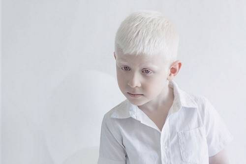 Этот нежный фотопроект об удивительных альбиносах заставит тебя по-другому взглянуть на «особенных».