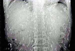 Когда врачи увидели рентген этого парня, у них отвисла челюсть! Ужасное зрелище!